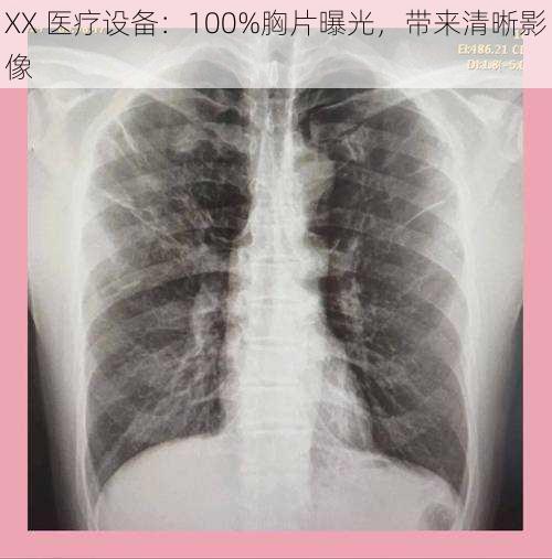 XX 医疗设备：100%胸片曝光，带来清晰影像