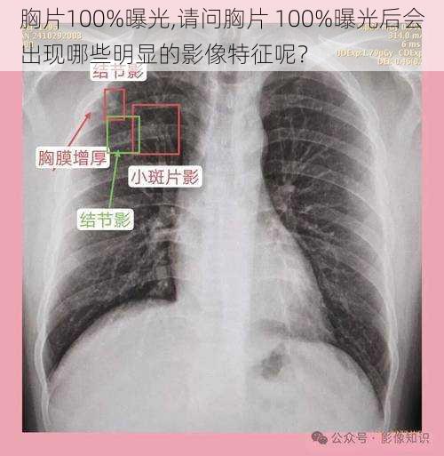 胸片100%曝光,请问胸片 100%曝光后会出现哪些明显的影像特征呢？